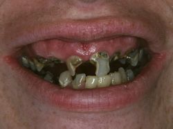 Rotten Teeth from Mountain Dew